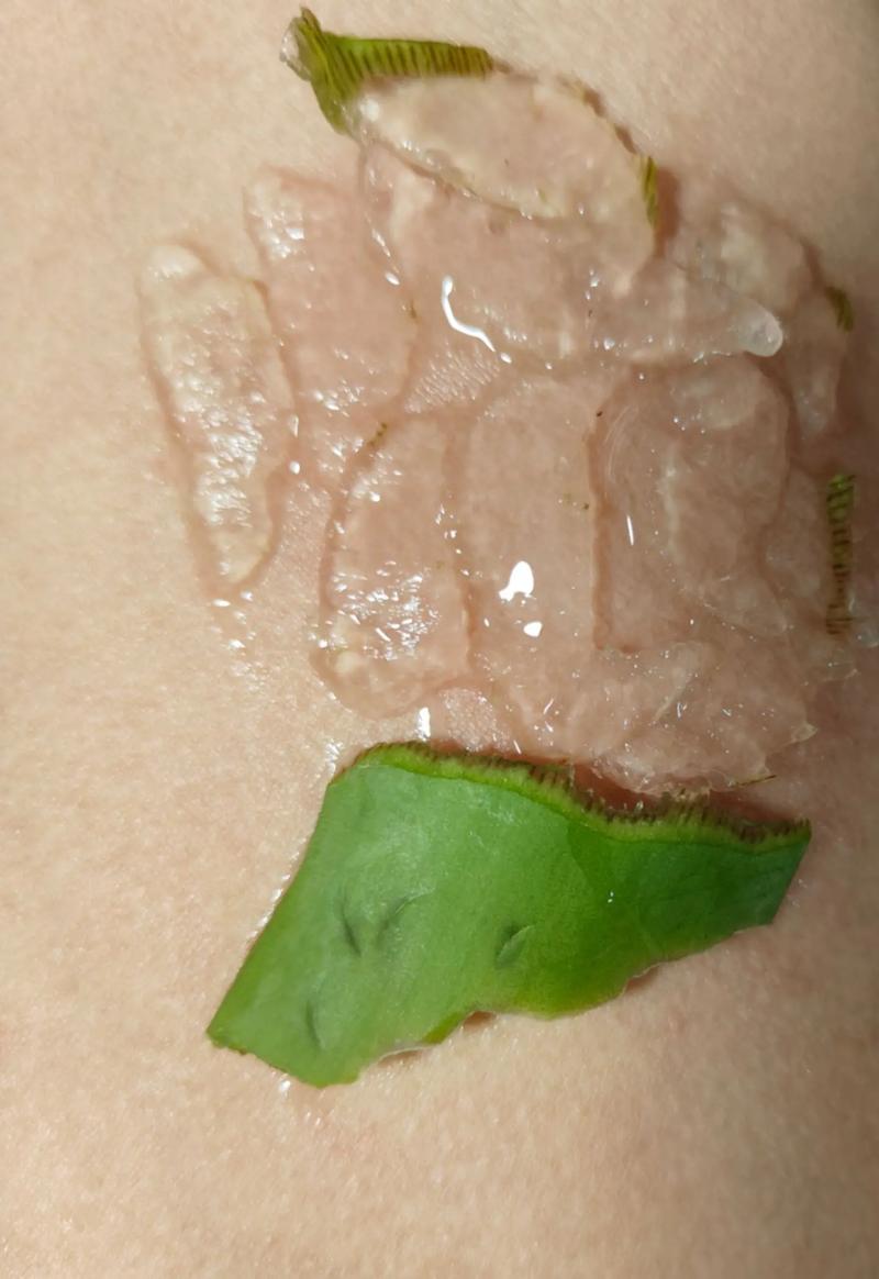 新鲜芦荟对烫伤有用吗，新鲜芦荟怎样祛痘？新鲜芦荟对治疗烫伤有用吗？-第5张图片-优品飞百科