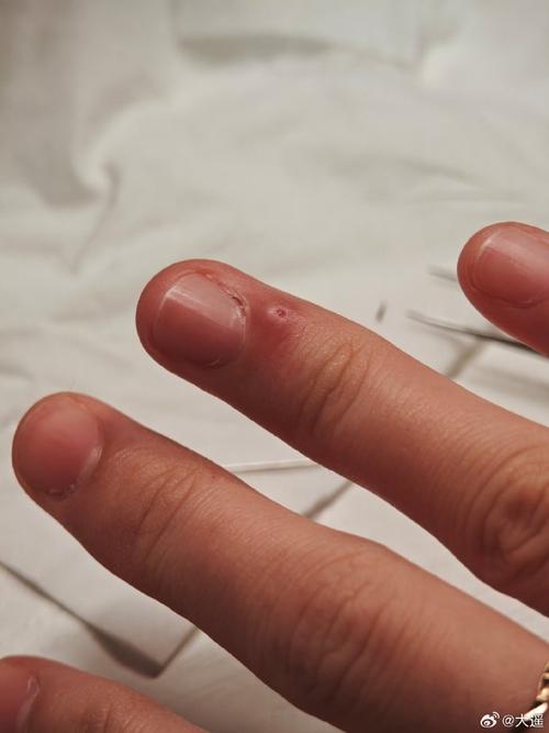 玫瑰刺有毒吗,被扎伤后该怎么处理?,玫瑰刺扎了怎么办?-第1张图片-优品飞百科 玫瑰刺有毒吗,被扎伤后该怎么处理?,玫瑰刺扎了怎么办?-第1张图片-优品飞百科