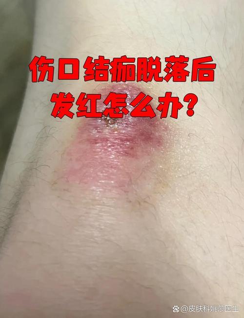 仙人掌烂半截怎么办？？仙人掌烂了一部分怎么办？-第2张图片-优品飞百科